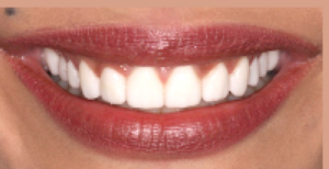 No Prep Veneers