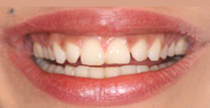 No Prep Veneers